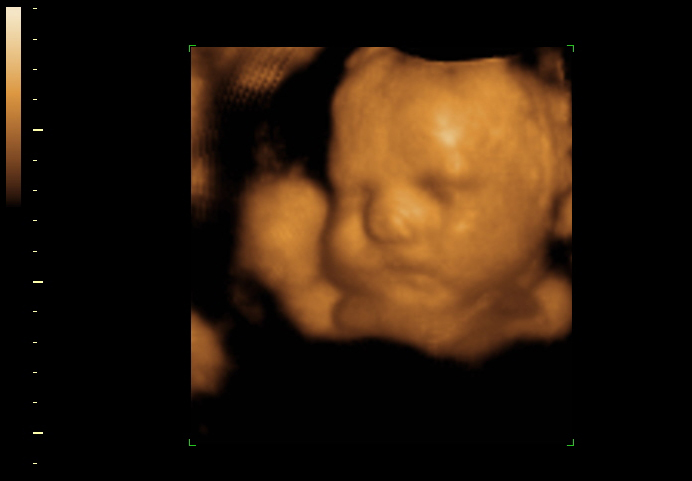 3D ultrasound image at 33 weeks